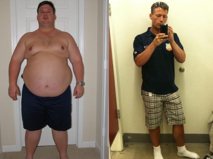 Vertical Sleeve Gastrectomy Forum (VSG)